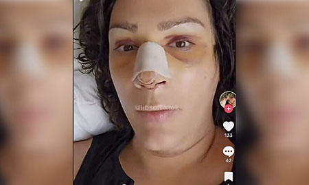 Your tax dollars at work: Facial feminization surgery for trans troops