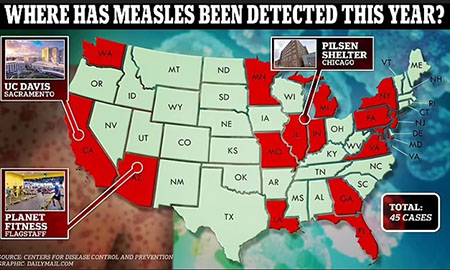 Measles outbreaks in 17 states as housing for illegals become infectious disease breeding grounds